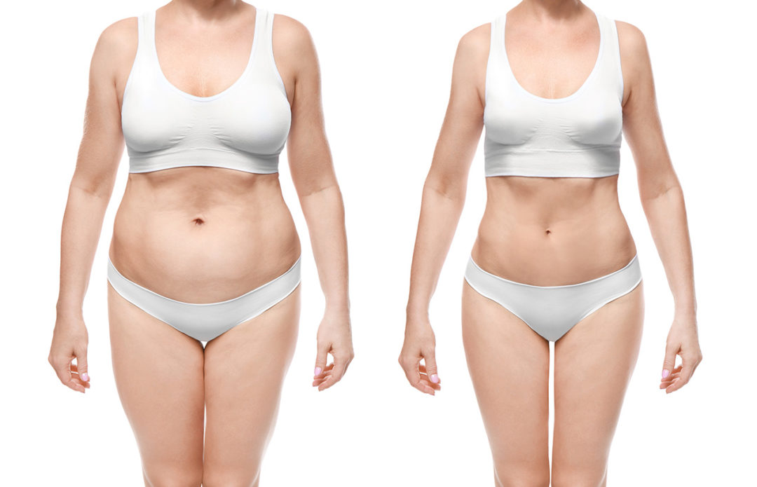 Benefits Of Non Invasive Liposuction My Self Care